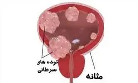 نشانه های سرطان مثانه چیست؟
