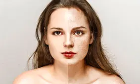 ۲۸ روش درمان خانگی کک و مک