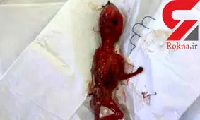 عکس دردناک از جنین کشف شده در دستشویی دبیرستان دخترانه+ جزییات