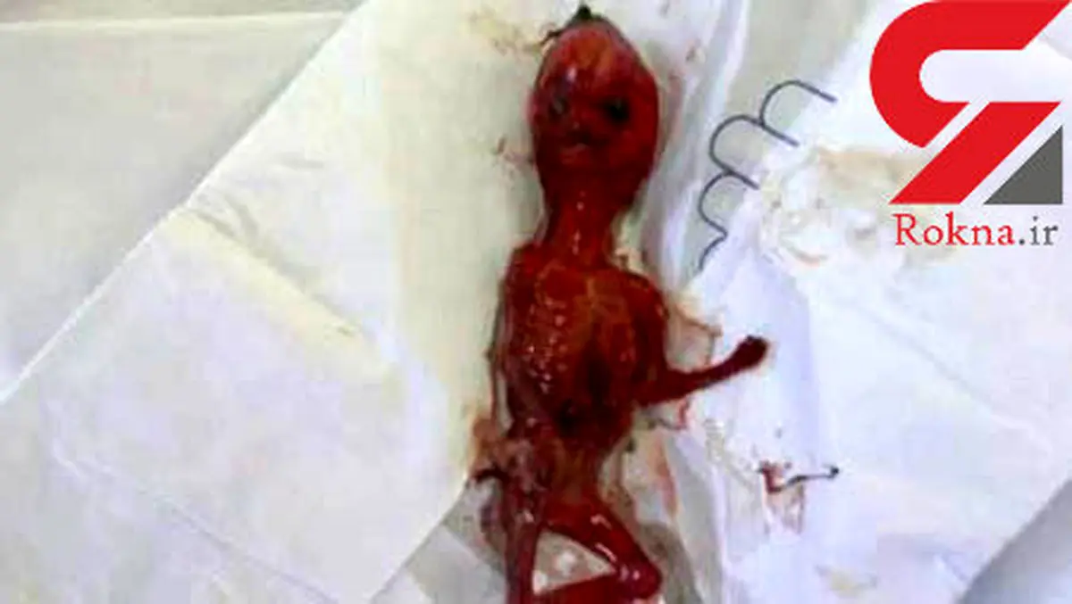 عکس دردناک از جنین کشف شده در دستشویی دبیرستان دخترانه+ جزییات
