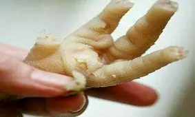 بهترین درمان سرما خوردگی