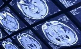 درمان تومورهای چشمی و مغزی ۵۵ بیمار با روش رادیوتراپی داخلی