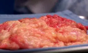 خارج کردن تومور 30 ساله از بازو + تصاویر 16+