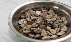 خارج کردن یک کاسه سنگ و فلز از شکم بیمار + عکس