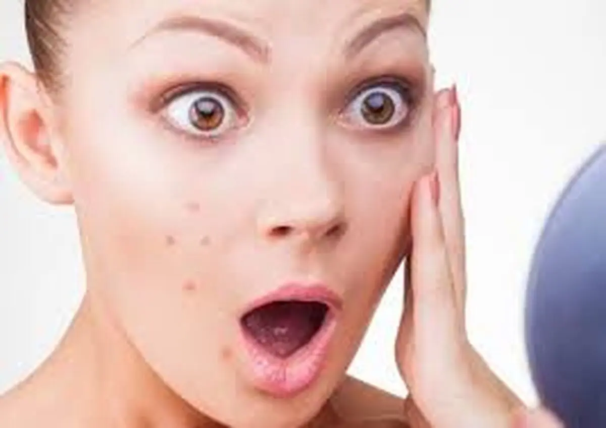 ماسک صورت جوش را بدتر می کند / قلیان در جوش زدن تاثیر دارد؟