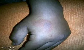 معلم با قاشق داغ دست دانش‌آموز نظرآبادی را سوزانده است؟