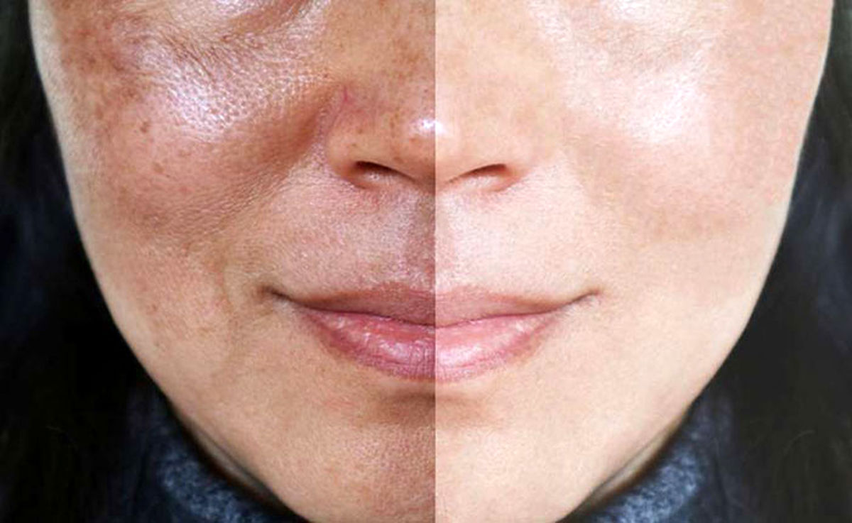 از بین بردن منافذ باز پوست با روش های خانگی و پزشکی