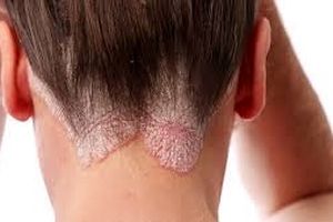 این 7 بیماری مسری است اما از آن بی خبرید!