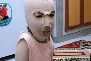 مادر و پدر دنیا جلوی چشمانش زنده زنده در آتش سوختند + عکس