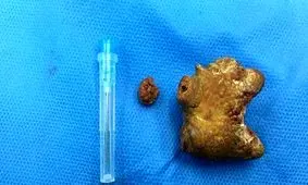 پزشکان یک کیلو سنگ از مثانه دختر ۱۸ ساله خارج کردند