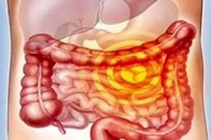 چگونه با سرطان روده مبارزه کنیم؟