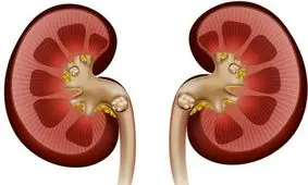 مهم ترین عامل ابتلا به سنگ کلیه چیست؟