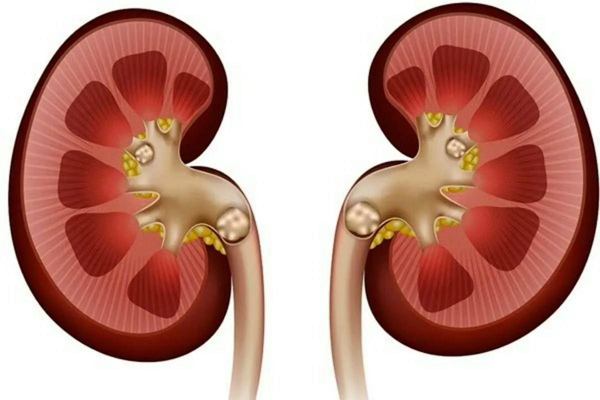 مهم ترین عامل ابتلا به سنگ کلیه چیست؟