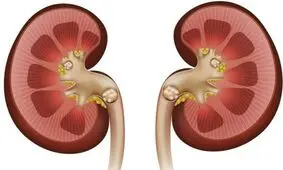مهم ترین عامل ابتلا به سنگ کلیه چیست؟