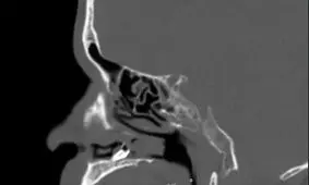 دماغ یک مرد دانمارکی دندان درآورد!