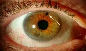 این بیماری خطرناک چشمی را بشناسید