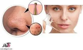 درمان جوش های سرسیاه با ترفندهای خانگی