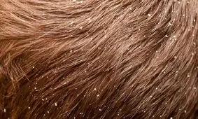 ۱۱ درمان طبیعی برای خلاصی از شوره سر