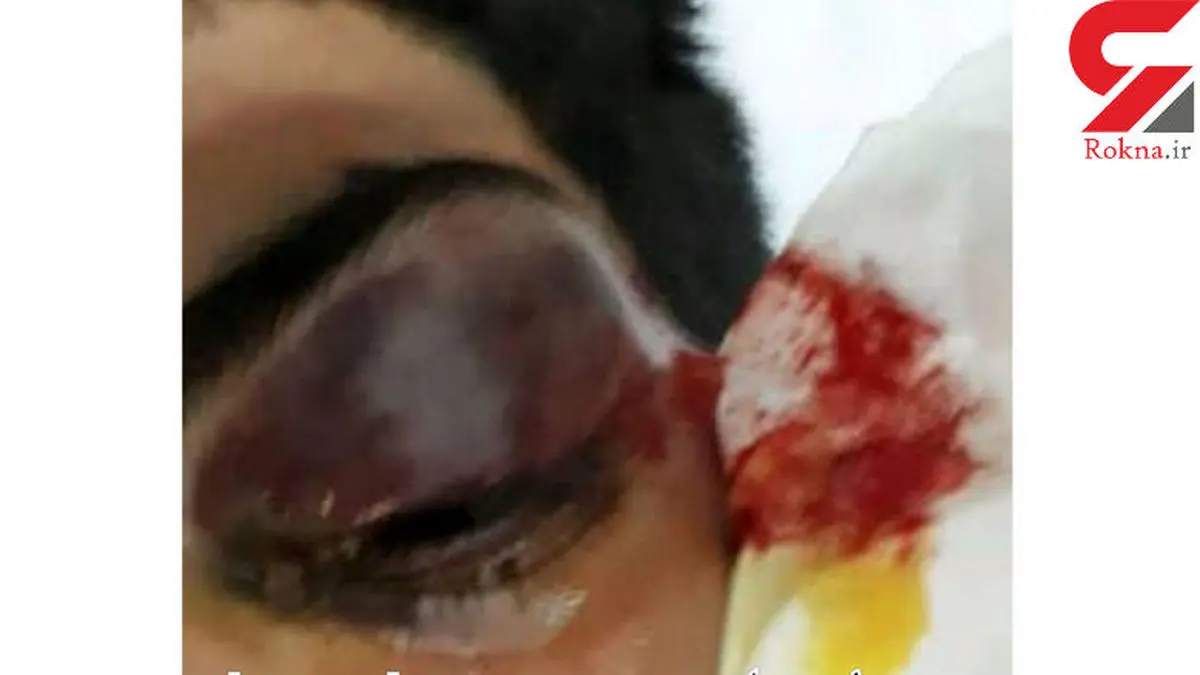 پسر کرمانی فازمتر را در چشم همکلاسی اش فرو کرد+ عکس