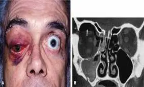 بازسازی کاسه چشم با محصولات دانش‌بنیان