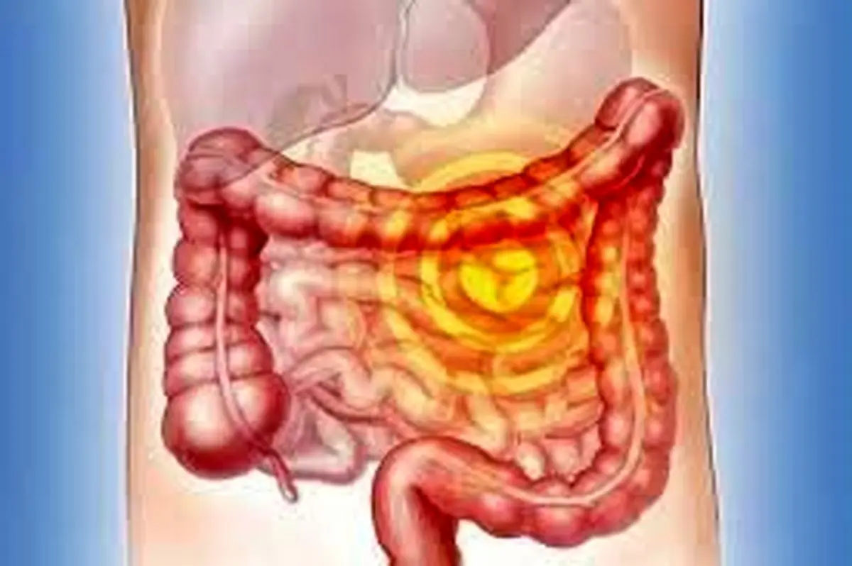 تاثیر بیان نسبی ژن‌ها در پیشرفت بدخیمی سرطان روده بزرگ