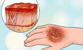 اختراع پماد التیام‌بخش سریع زخم‌های سوختگی