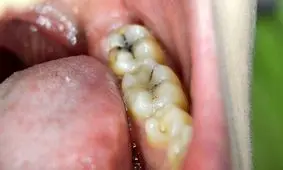 رابطه باکتری دهان و سرطان کولورکتال