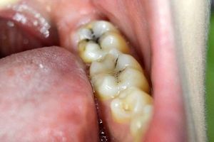 رابطه باکتری دهان و سرطان کولورکتال