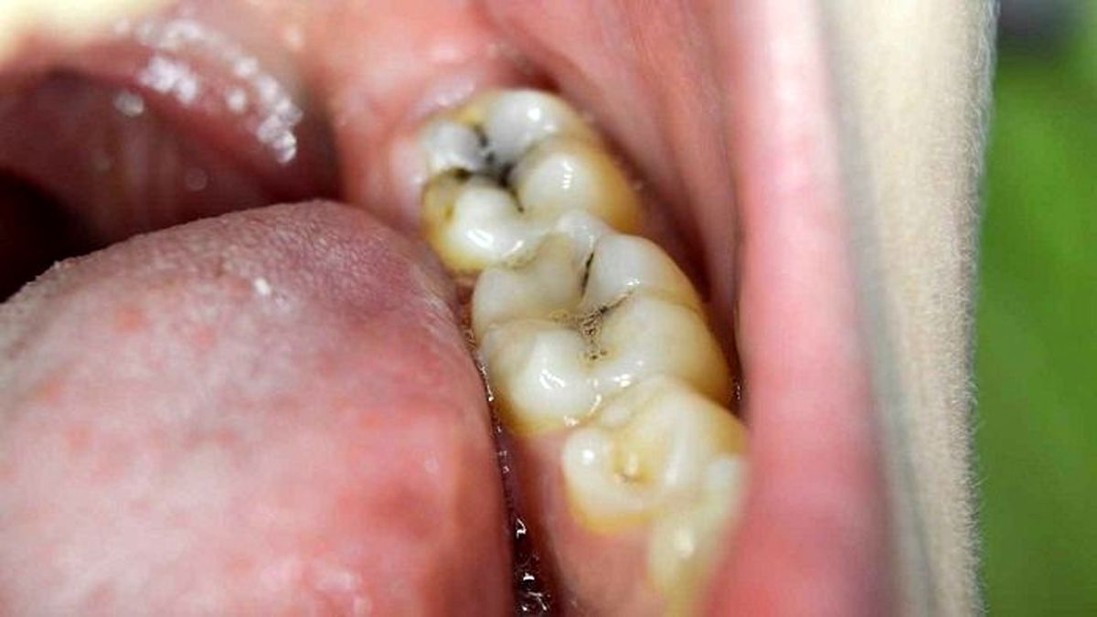 رابطه باکتری دهان و سرطان کولورکتال