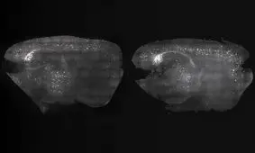 بهبود آلزایمر با کمک تحریک امواج مغزی