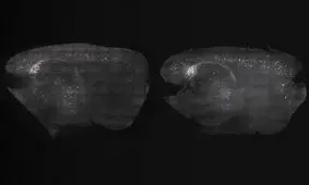 بهبود آلزایمر با کمک تحریک امواج مغزی