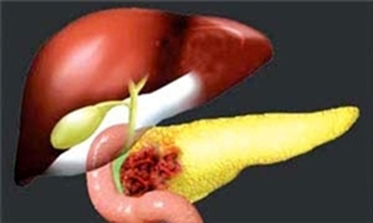«سرطان لوزالمعده» در صدر سرطان‌های کشنده