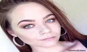 دختر زیبا با حساسیت به رنگ مو چشم قورباغه ای شد +عکس