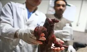 قطع شدن دست یک جوان ارومیه‌ای در چهارشنبه آخر سال