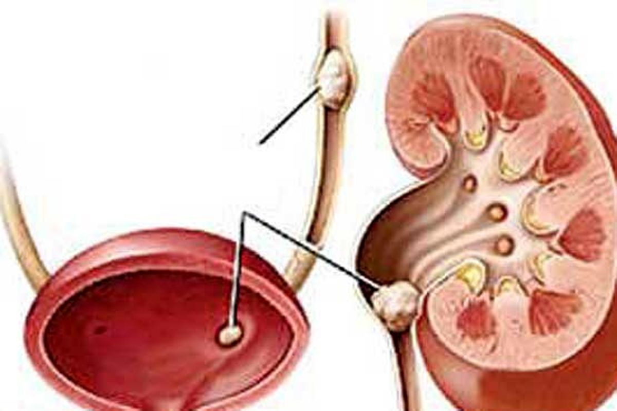 آبلیمو معجزهای برای رفع سنگ کلیه