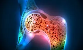 هفت عامل ابتلا به پوکی استخوان