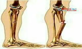 نشانه های پوکی استخوان