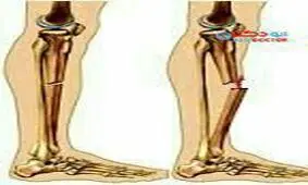 نشانه های پوکی استخوان