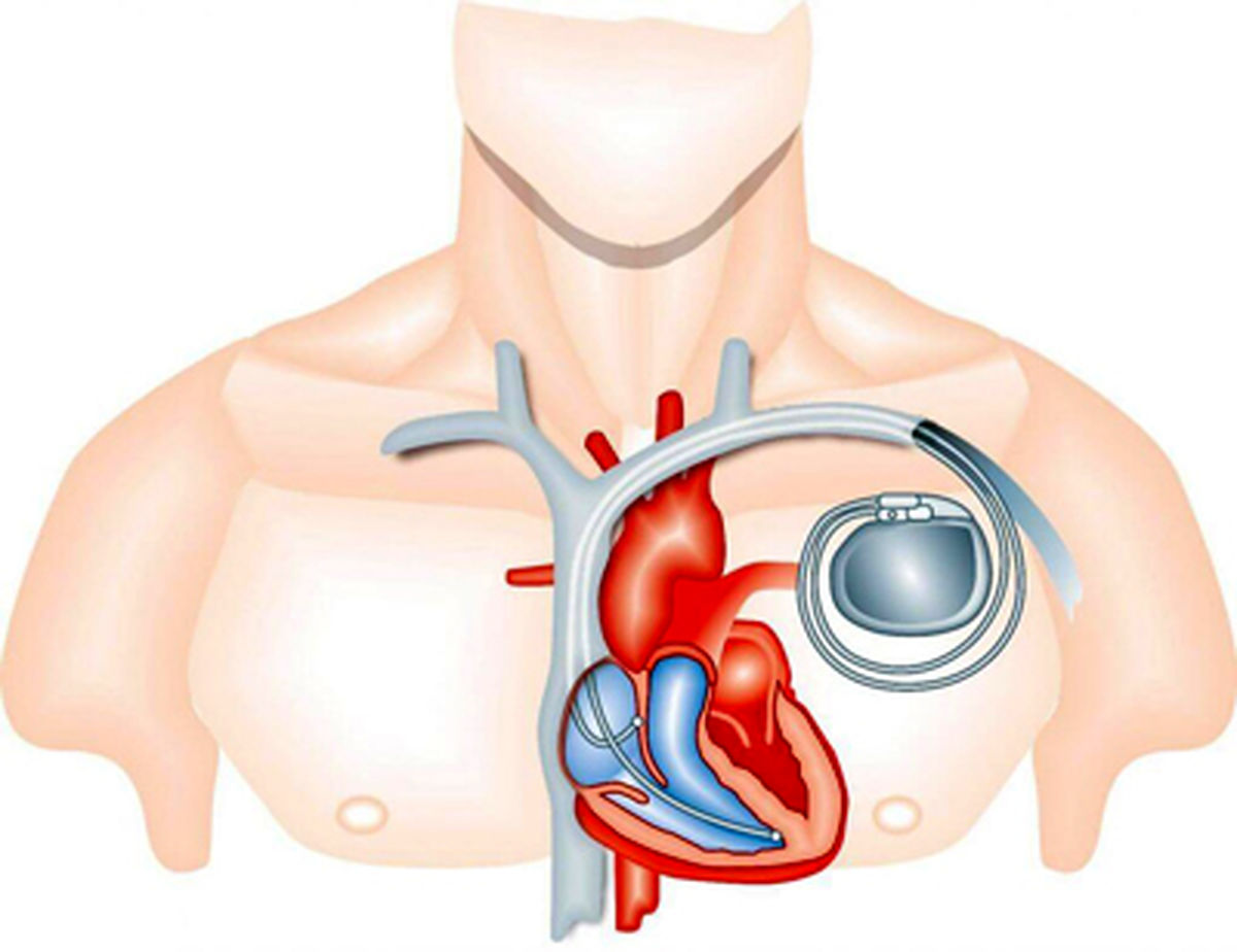 همه چیز درباره باتری قلب