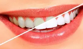 ترفند‌های طلایی برای برق انداختن دندان‌ها