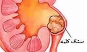همه چیز درباره سنگ کلیه