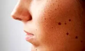 با خال‌های مزاحم چه کنیم؟