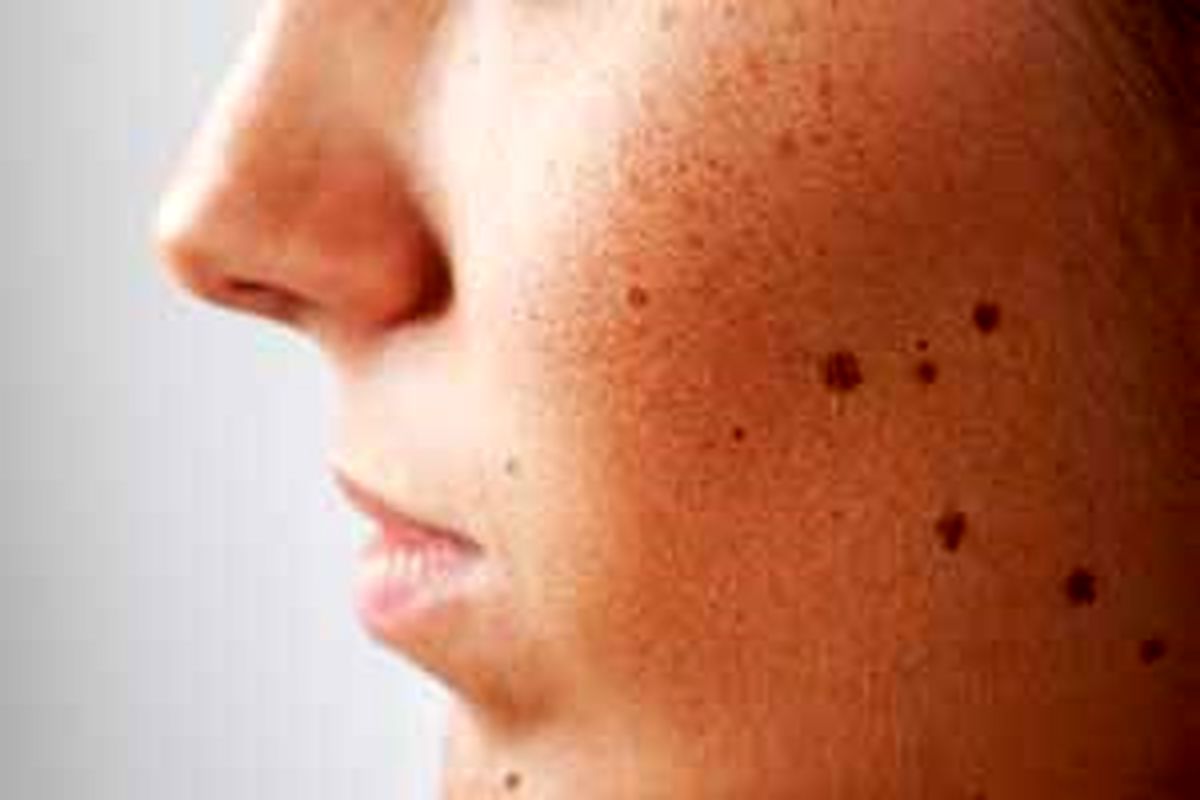 با خالهای مزاحم چه کنیم؟