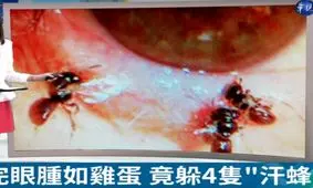 ۴ زنبور زیر پلک یک زن زندگی می کردند!
