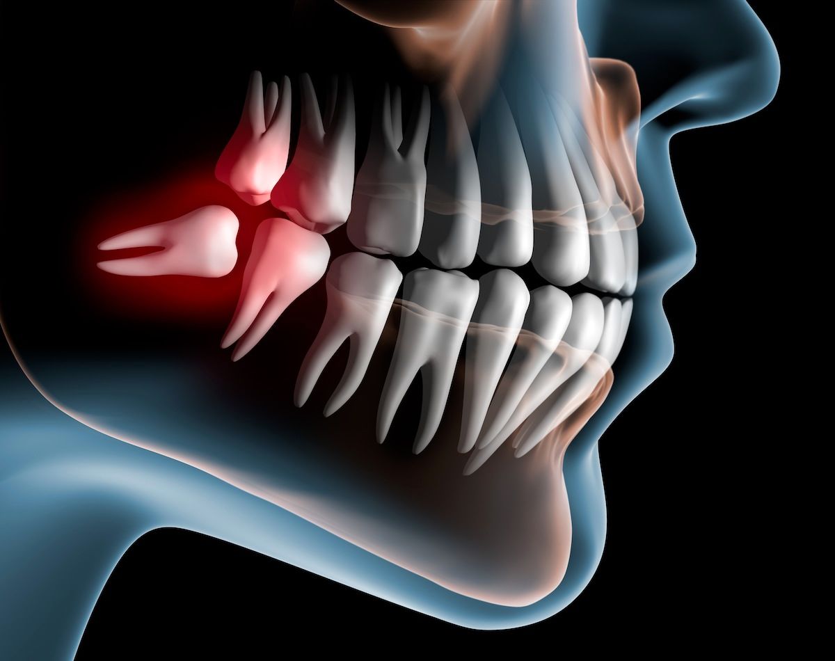 دلیل رشد دندان عقل چیست؟