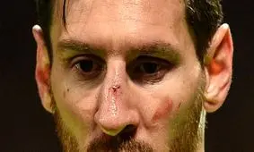 مصدومیت شدید مسی در دیدار منچستر - بارسلونا