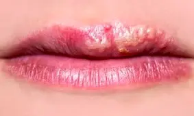 درمان فوری تبخال های دردناک