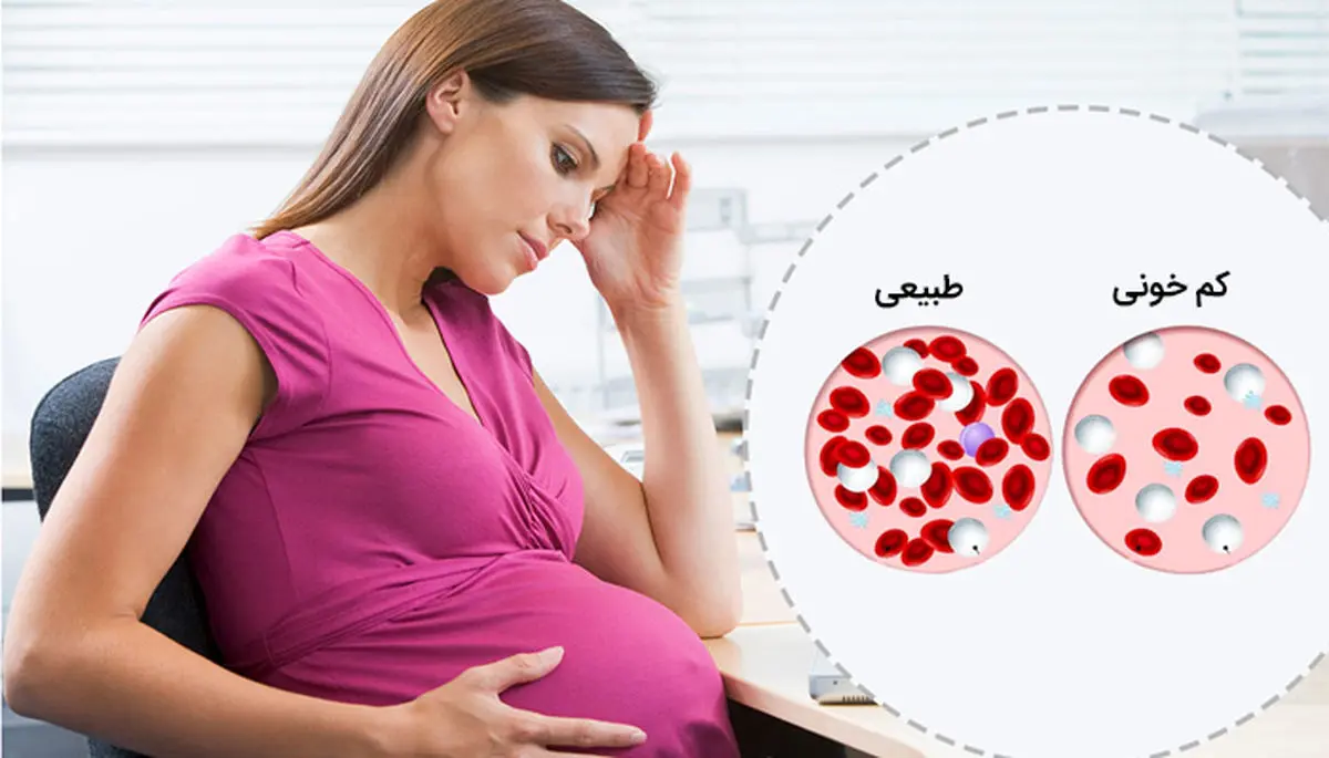 علائم کمبود آهن در بارداری چیست؟