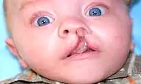 شکاف کام و لب در چند ماهگی سراغ جنین می‌آید؟