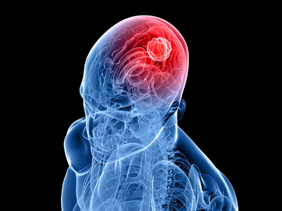 راهکارهای طلایی برای پیشگیری از سکته مغزی